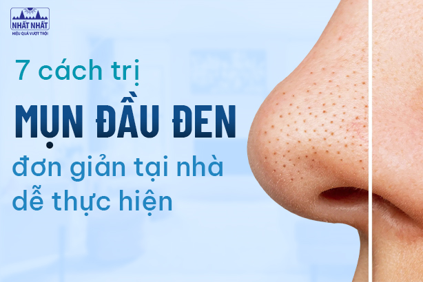 7 cách trị mụn đầu đen đơn giản tại nhà dễ thực hiện