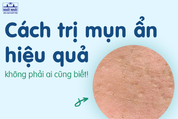 Cách trị mụn ẩn hiệu quả, không phải ai cũng biết!