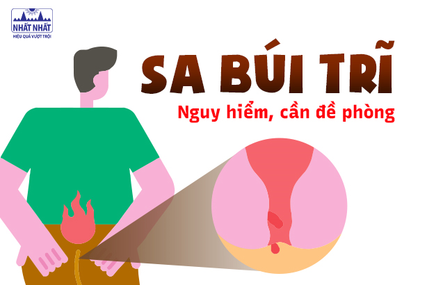 Sa búi trĩ – bệnh tế nhị nhưng nguy hiểm, cần đề phòng
