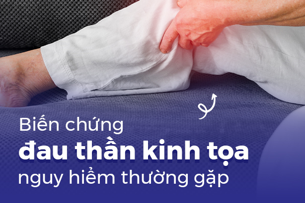 Biến chứng đau thần kinh tọa nguy hiểm thường gặp