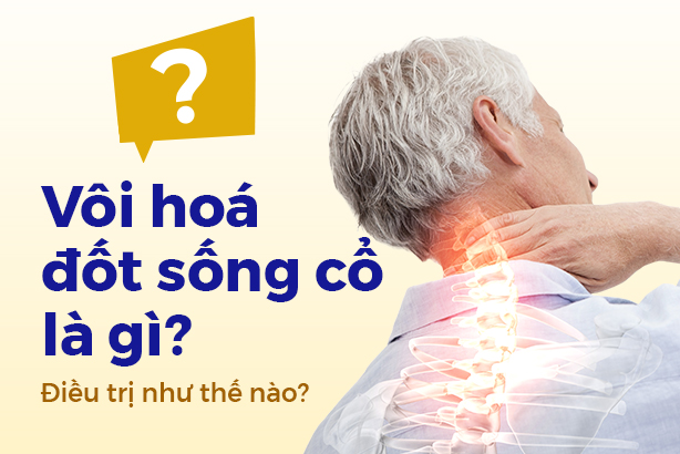 Vôi hóa đốt sống cổ là gì? Điều trị như thế nào?
