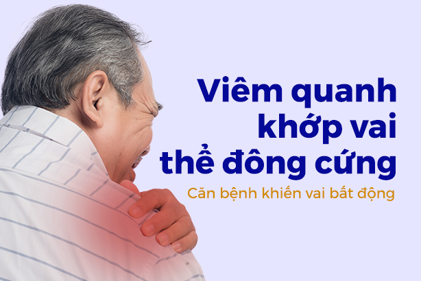 Viêm quanh khớp vai thể đông cứng – Căn bệnh khiến vai bất động