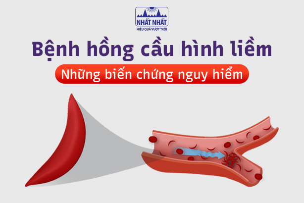 Bệnh hồng cầu hình liềm và những biến chứng nguy hiểm