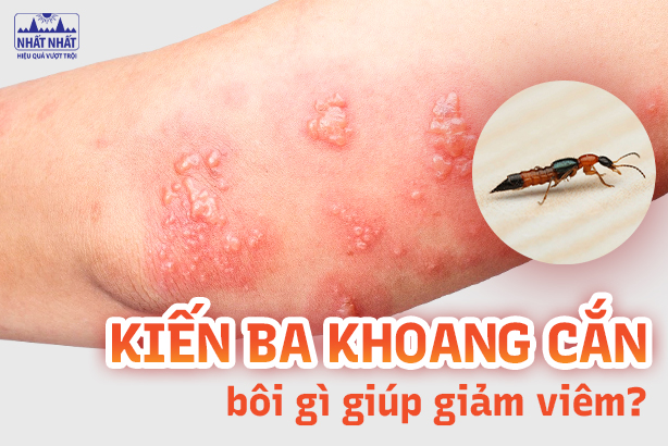 Kiến ba khoang cắn bôi gì giúp giảm viêm, ngăn ngừa sẹo?