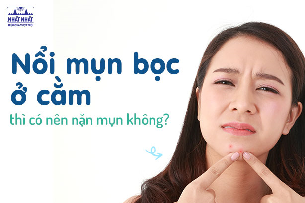 Nổi mụn bọc ở cằm thì có nên nặn mụn không?