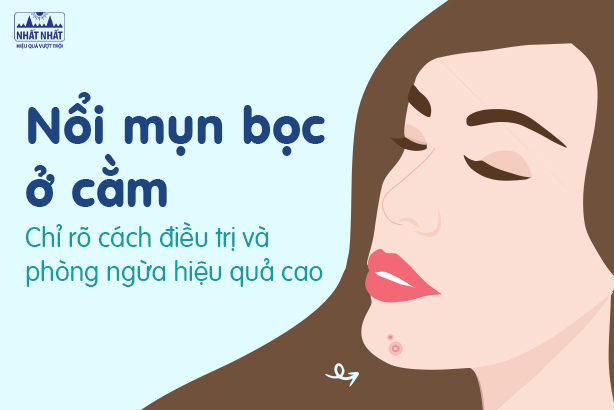 Nổi mụn bọc ở cằm: Chỉ rõ cách điều trị và phòng ngừa hiệu quả cao