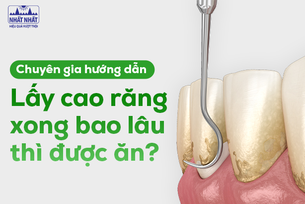 Chuyên gia hướng dẫn: Lấy cao răng xong bao lâu thì được ăn?