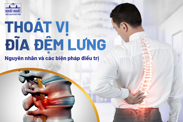 Thoát vị đĩa đệm lưng: Nguyên nhân và các biện pháp điều trị