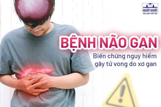 Bệnh não gan: Biến chứng nguy hiểm gây tử vong do xơ gan
