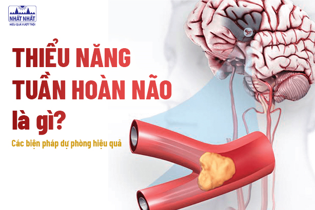 Thiểu năng tuần hoàn não là gì? Các biện pháp dự phòng hiệu quả