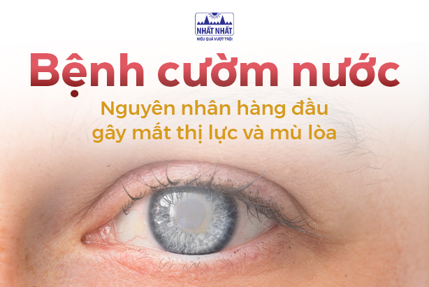 Bệnh cườm nước: Nguyên nhân hàng đầu gây mất thị lực và mù lòa 