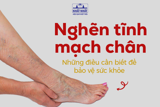 Nghẽn tĩnh mạch chân – Những điều cần biết để bảo vệ sức khỏe