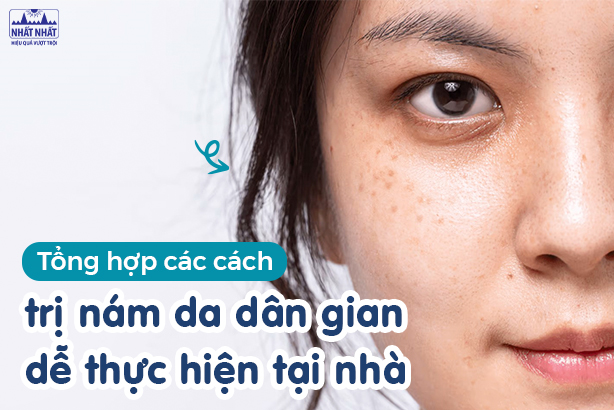 Tổng hợp các cách trị nám da dân gian dễ thực hiện tại nhà 