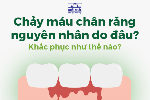 Chảy máu chân răng nguyên nhân do đâu? Khắc phục như thế nào?