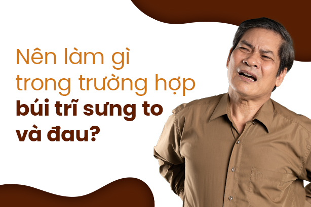 Nên làm gì trong trường hợp búi trĩ sưng to và đau?