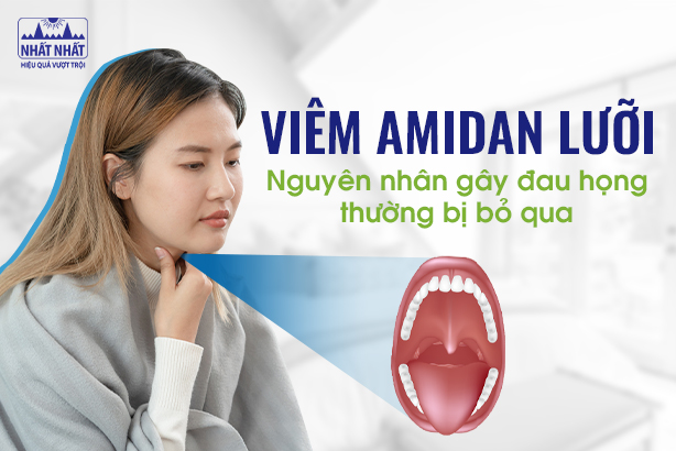 Viêm amidan lưỡi: Nguyên nhân gây đau họng thường bị bỏ qua