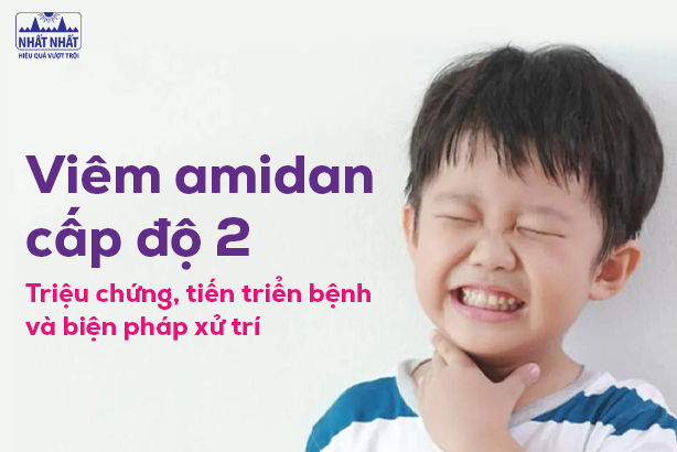 Viêm amidan cấp độ 2: Triệu chứng, tiến triển bệnh và biện pháp xử trí