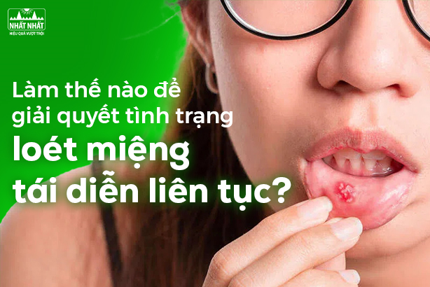 Làm thế nào để giải quyết tình trạng loét miệng tái diễn liên tục?