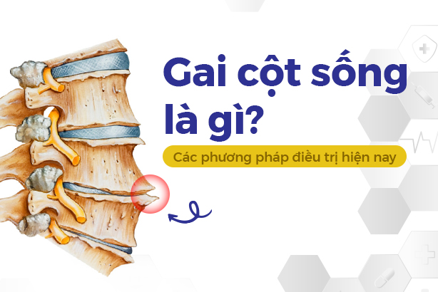 Gai cột sống là gì? Các phương pháp điều trị hiện nay