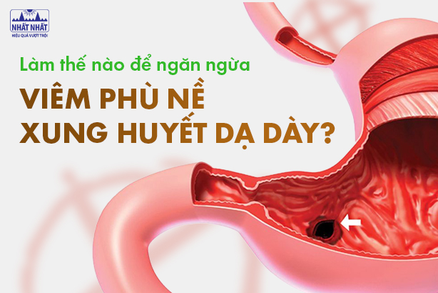 Làm thế nào để ngăn ngừa viêm phù nề xung huyết dạ dày?