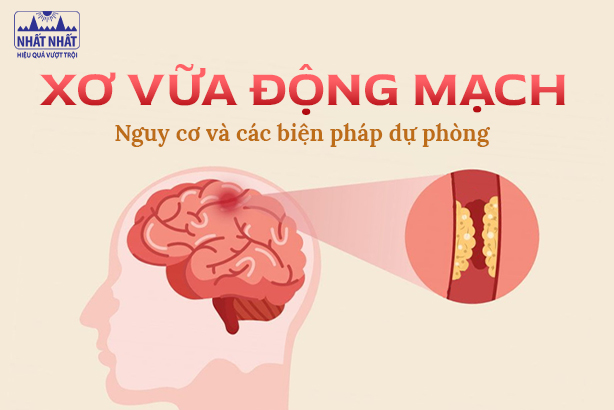 Xơ vữa động mạch: Nguy cơ và các biện pháp dự phòng