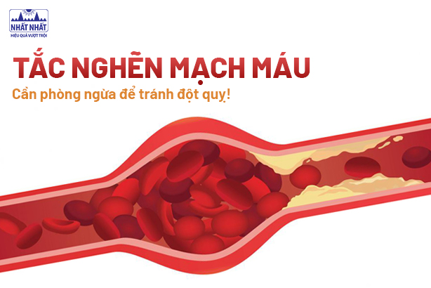 Tắc nghẽn mạch máu – Cần phòng ngừa để tránh đột quỵ!