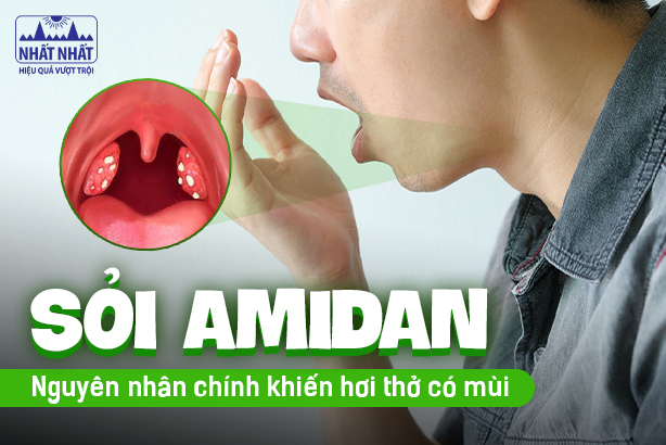 Sỏi amidan: Nguyên nhân chính khiến hơi thở có mùi mà nhiều người chưa biết