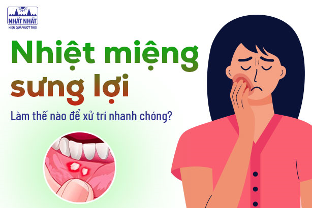 Nhiệt miệng sưng lợi: Làm thế nào để xử trí nhanh chóng?