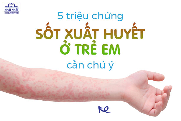 5 triệu chứng sốt xuất huyết ở trẻ em cần chú ý