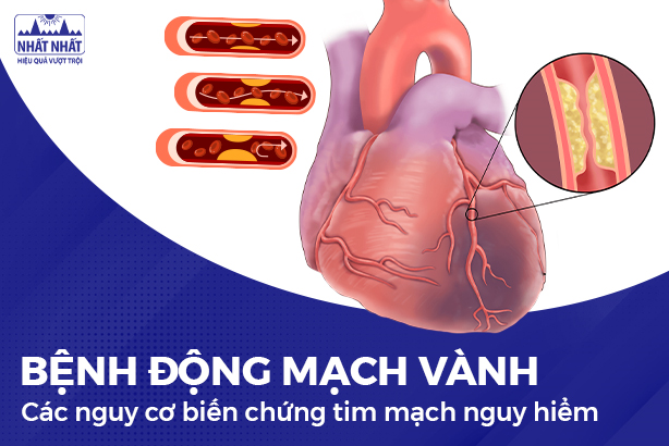 Bệnh động mạch vành và các nguy cơ biến chứng tim mạch nguy hiểm