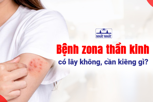 Bệnh zona thần kinh có lây không, cần kiêng gì?