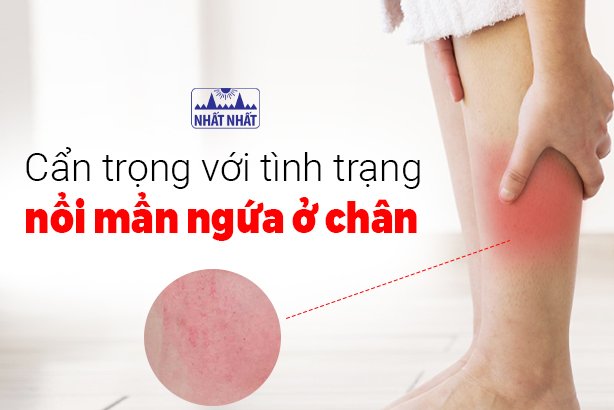 Cẩn trọng với tình trạng nổi mẩn ngứa ở chân