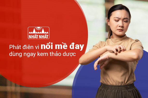 Phát điên vì nổi mề đay – dùng ngay kem thảo dược!