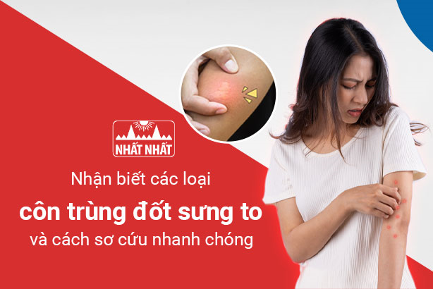 Nhận biết các loại côn trùng đốt sưng to và cách sơ cứu nhanh chóng