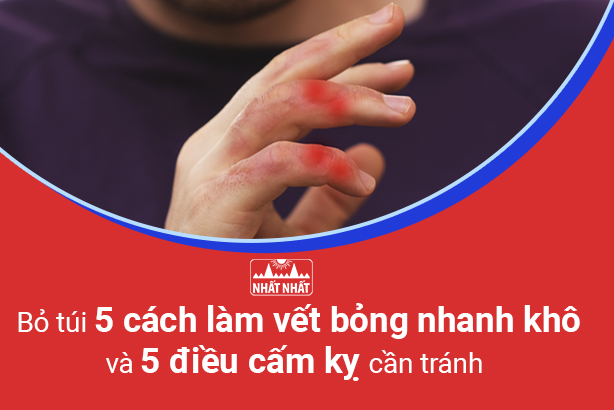 Bỏ túi 5 cách làm vết bỏng nhanh khô và 5 điều cấm kỵ cần tránh