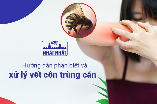 Hướng dẫn phân biệt và xử lý vết côn trùng cắn