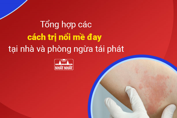 Tổng hợp các cách trị nổi mề đay tại nhà và phòng ngừa tái phát