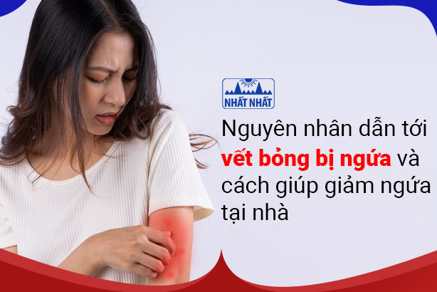 Nguyên nhân dẫn tới vết bỏng bị ngứa và cách giúp giảm ngứa tại nhà
