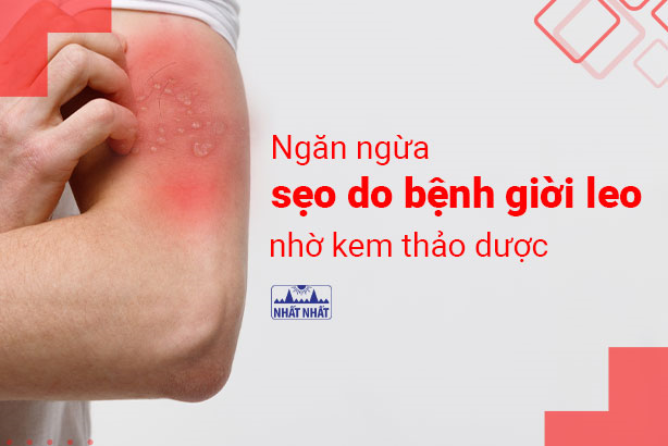 Ngăn ngừa sẹo do bệnh giời leo nhờ kem thảo dược
