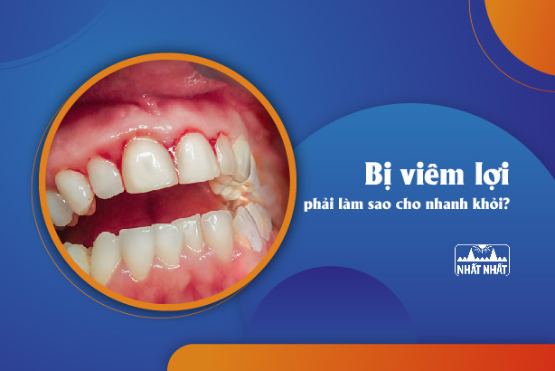 Giải đáp thắc mắc “Bị viêm lợi phải làm sao cho nhanh khỏi?”