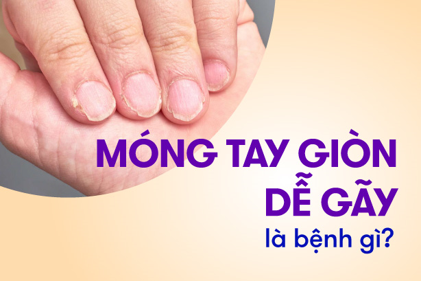 Móng tay giòn dễ gãy là bệnh gì, thiếu chất gì?