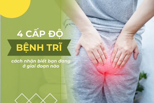 4 cấp độ bệnh trĩ – Cách nhận biết bạn đang ở giai đoạn nào