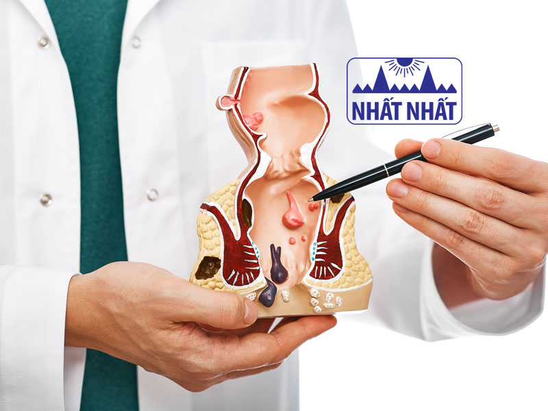 Những điều cần biết về bệnh trĩ và cách điều trị tại nhà