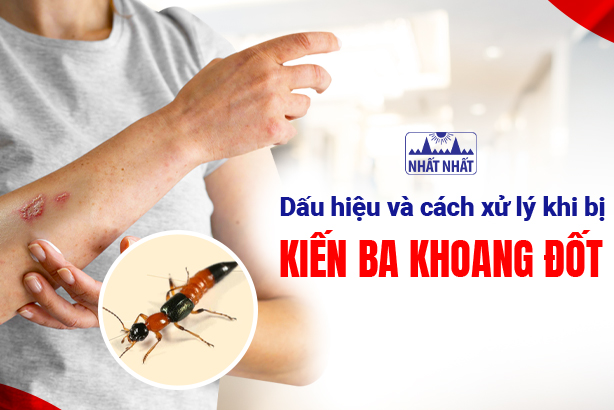 Dấu hiệu và cách xử lý khi bị kiến ba khoang đốt