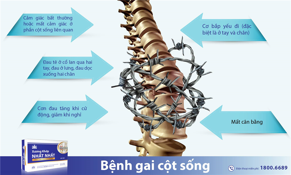 Bệnh gai đốt sống: Nguyên nhân, triệu chứng và điều trị