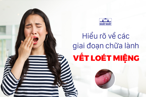 Hiểu rõ về các giai đoạn chữa lành vết loét miệng