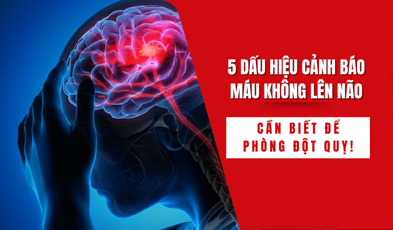 5 dấu hiệu cảnh báo máu không lên não – cần biết để phòng đột quỵ!