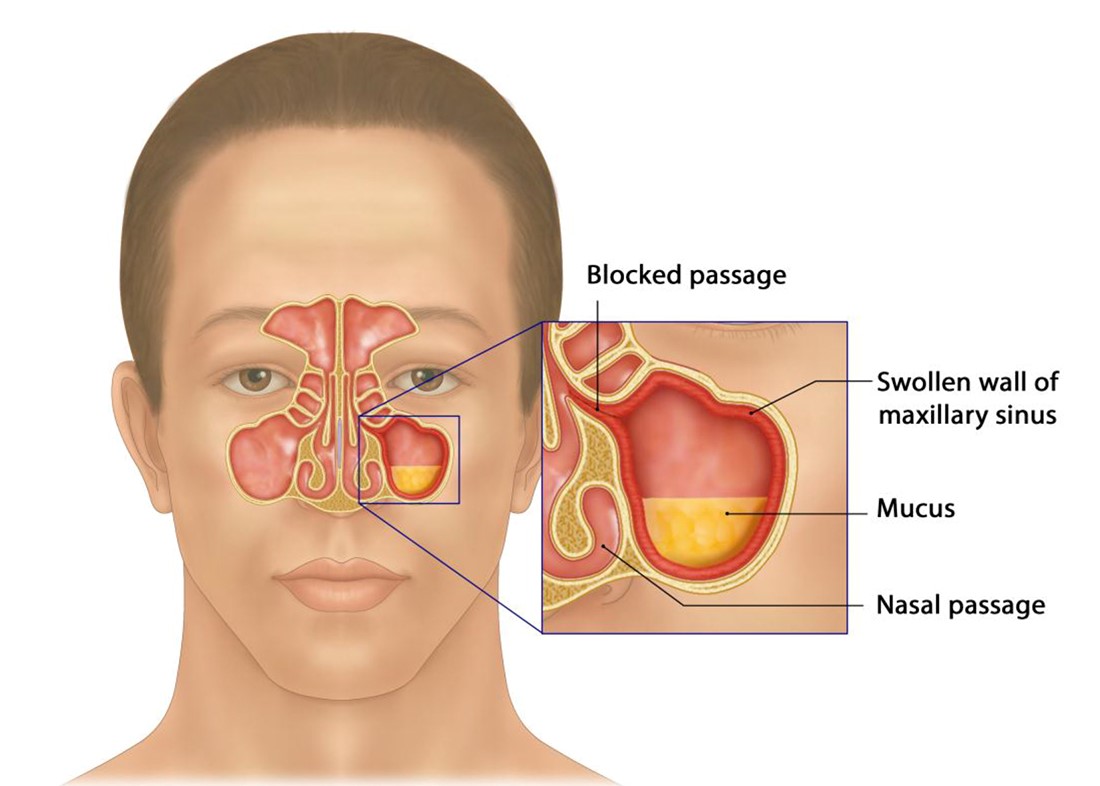 Viêm xoang mạn tính xảy ra khi sự viêm nhiễm tái đi tái lại nhiều lần làm niêm mạc mũi bị phù nề và dịch nhầy gây bít tắc các lỗ thông xoang