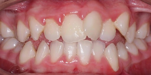 Răng khấp khểnh khiến vệ sinh răng miệng khó khăn có thể gây chảy máu chân răng
