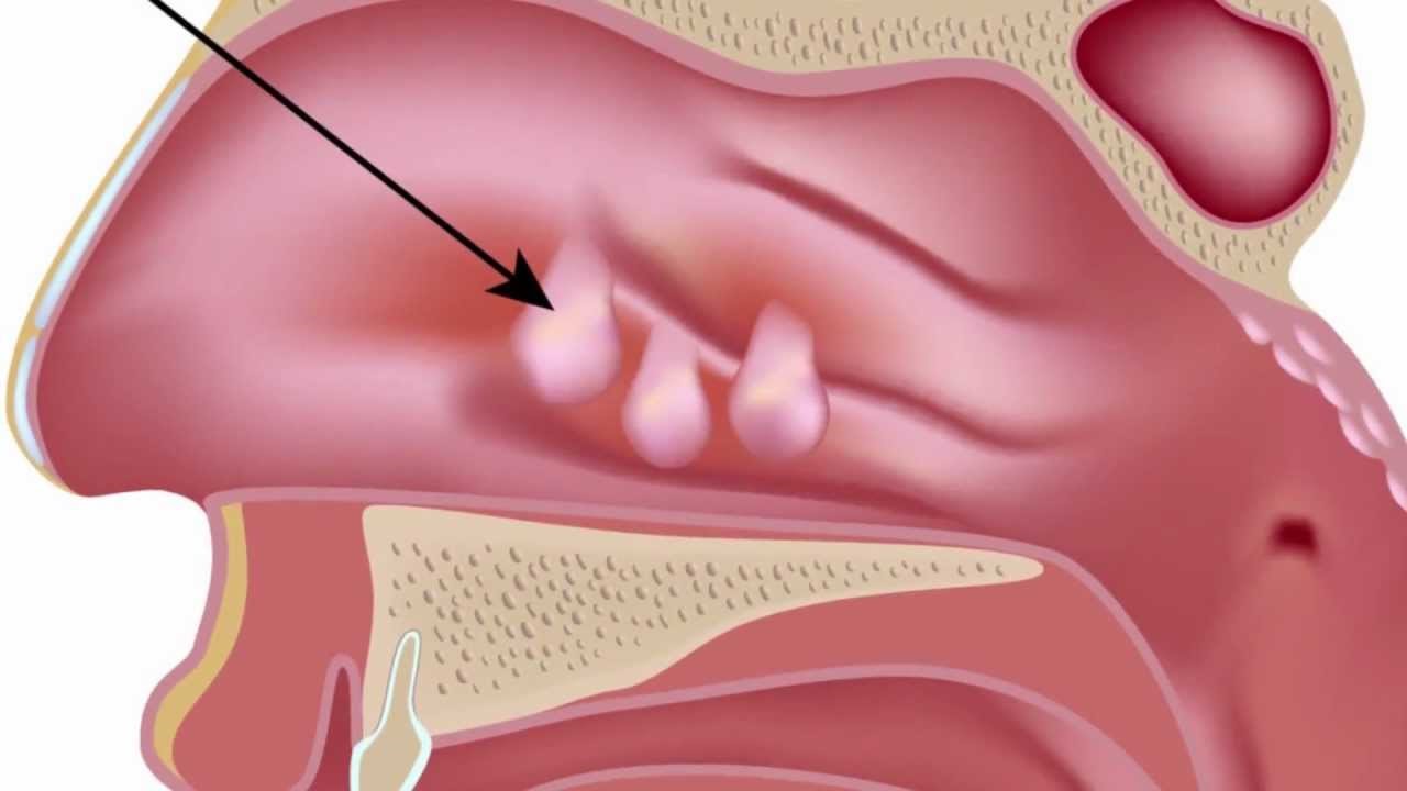 Các khối u polyp mũi gây nghẹt mũi ở bên chúng xuất hiện